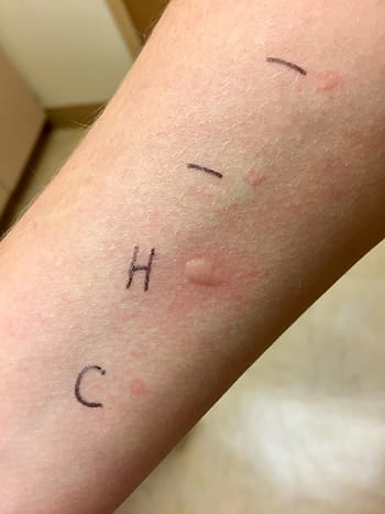 If the test is positive, a small hive the size of a mosquito bite develops