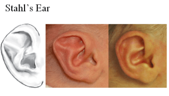 Stahl's Ear