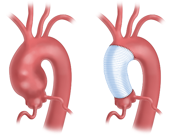 An aortic root replacement procedure replaces a section of the aorta with an artificial tube, or graft. The aortic valve is also removed and replaced with a mechanical or biological valve. 